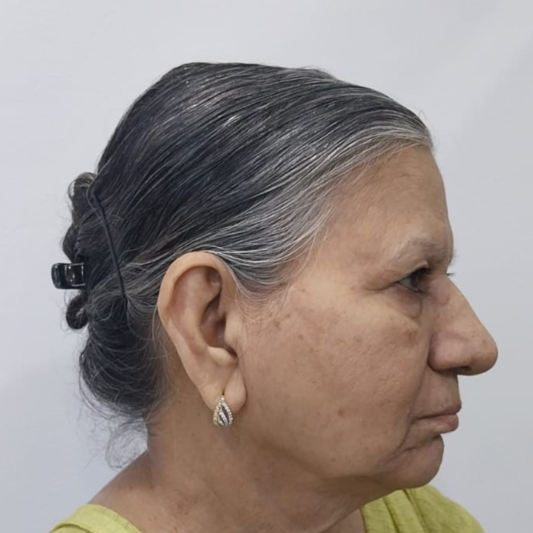 Image after Botox Filling