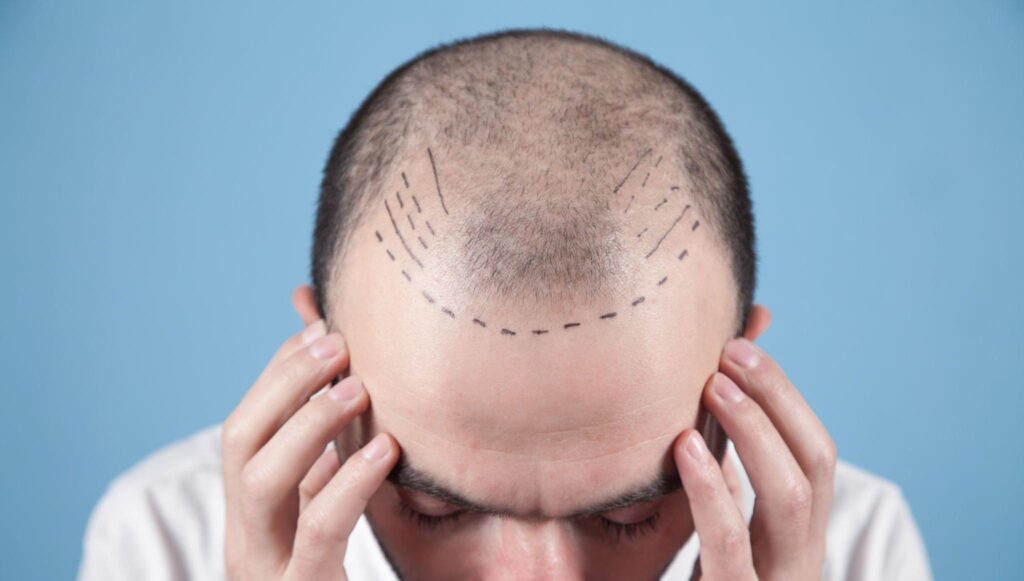 Image for Hair Transplant in Dwarka