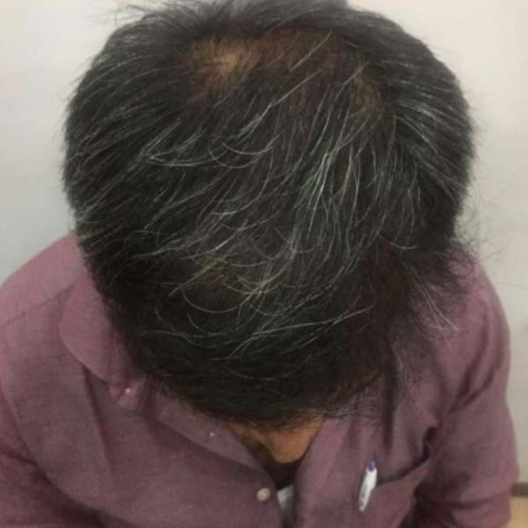 After Hair Transplant Treatment