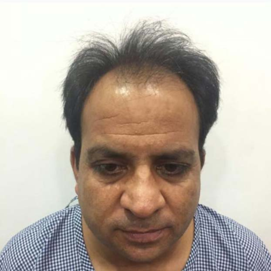 Before Hair Transplant Treatment