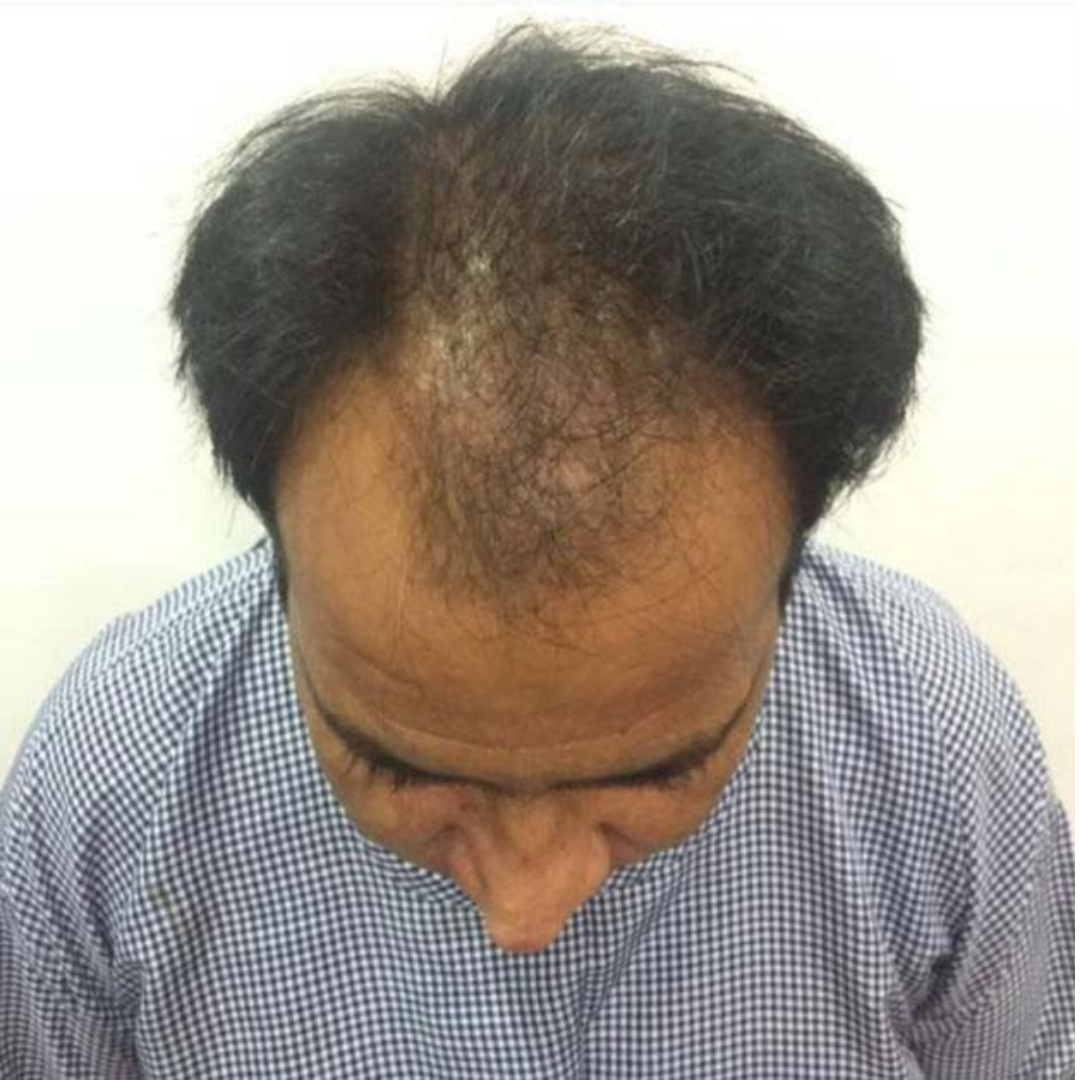 Before Hair Transplant Treatment