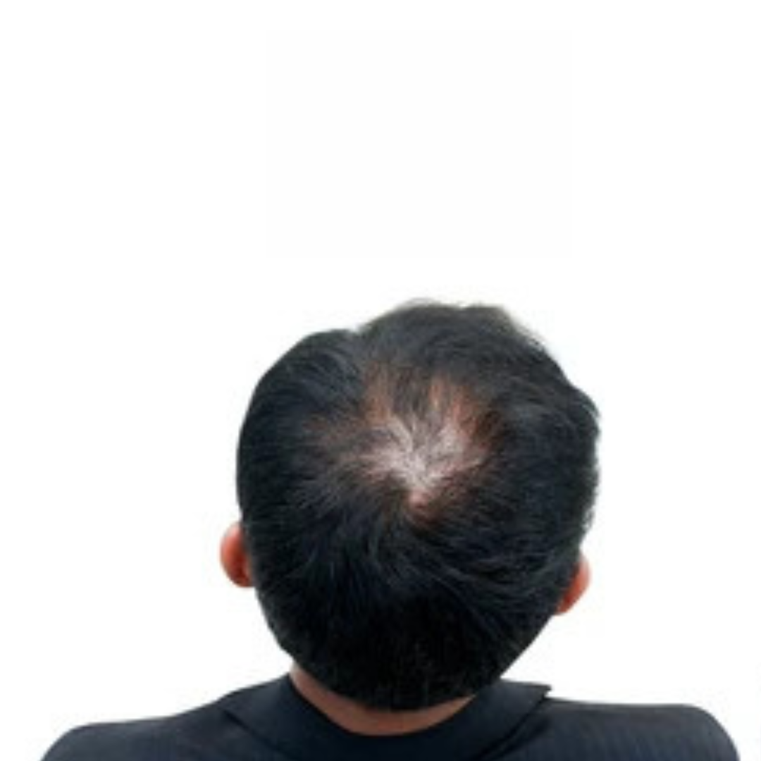 Before Hair Transplant Treatment