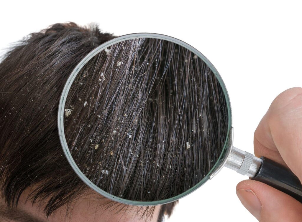 Hair Dandruff treatment in Dwarka