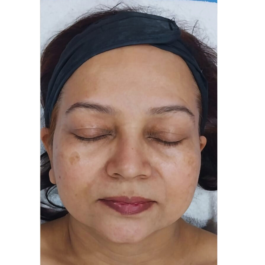 After Hydra facial