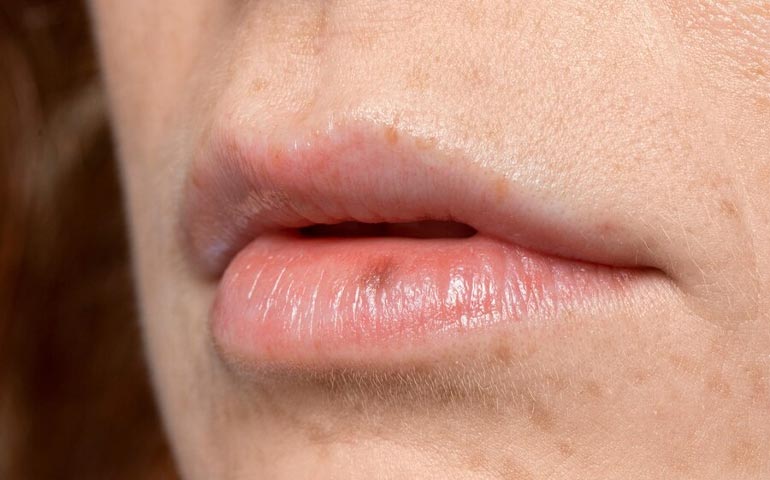 Dark Lips Treatment in Dwarka
