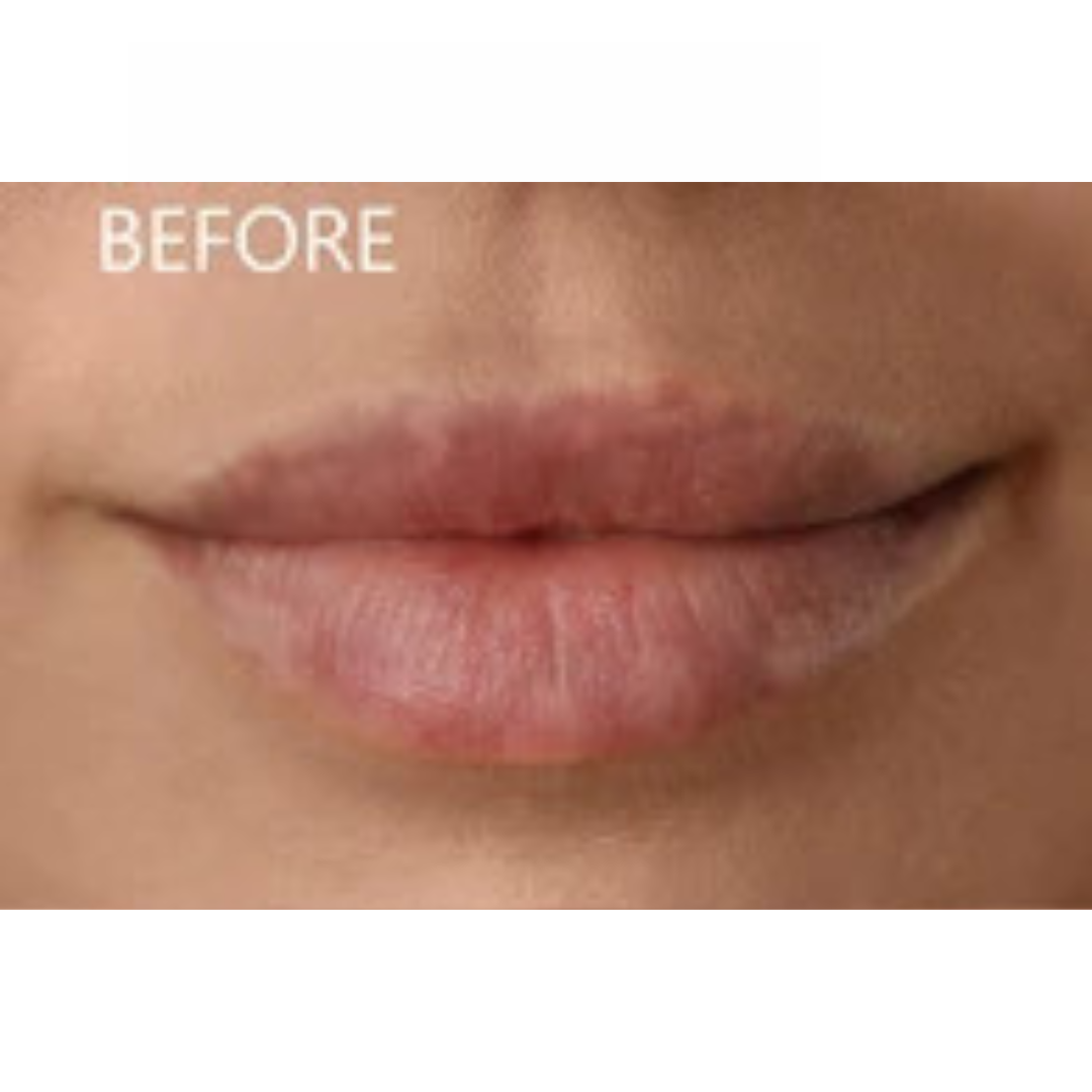 Dark Lips Before Lip Hyperpigmentation Treatment