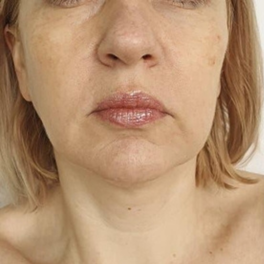 Face Before PDO thread Skin Tightening