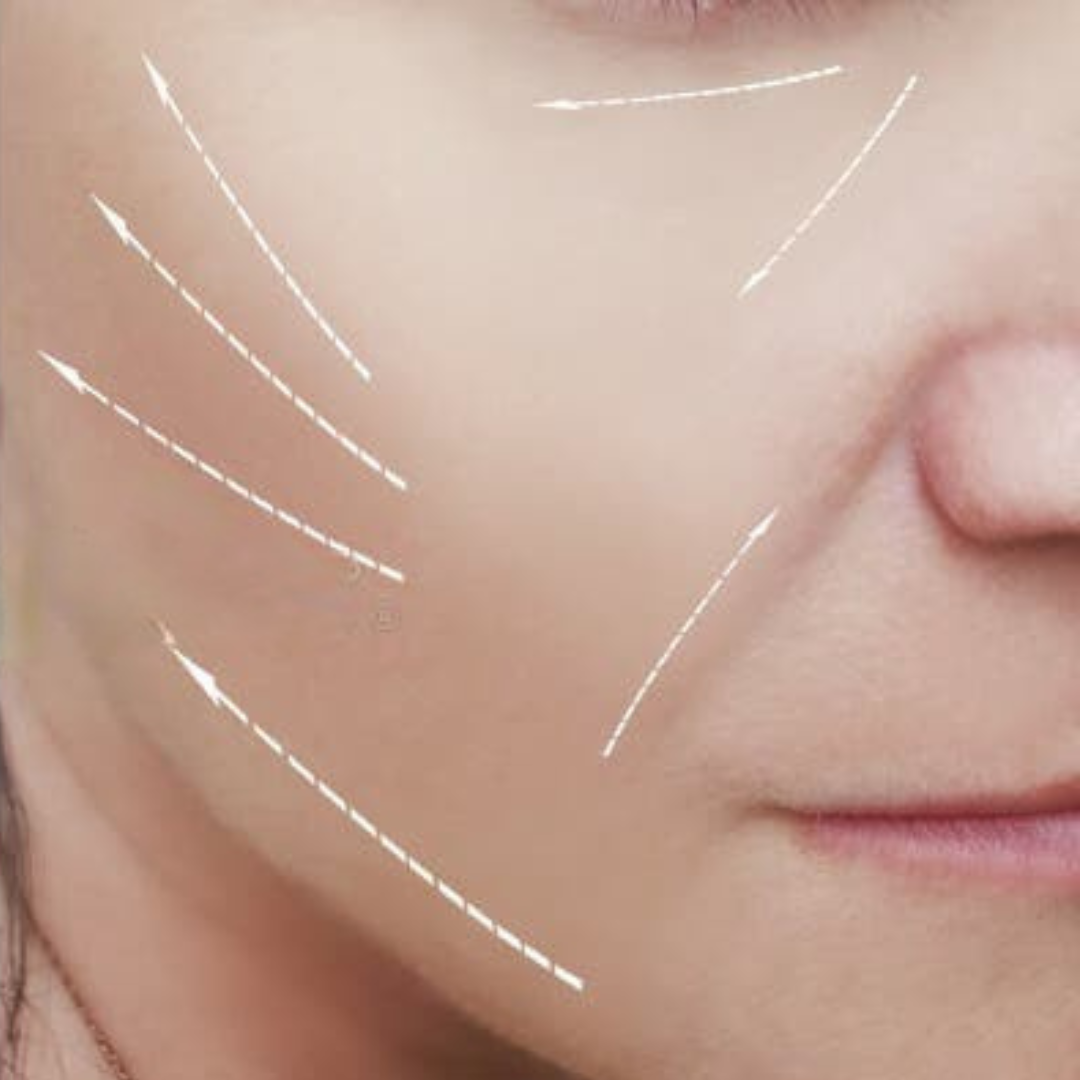 Face After PDO thread Skin Tightening
