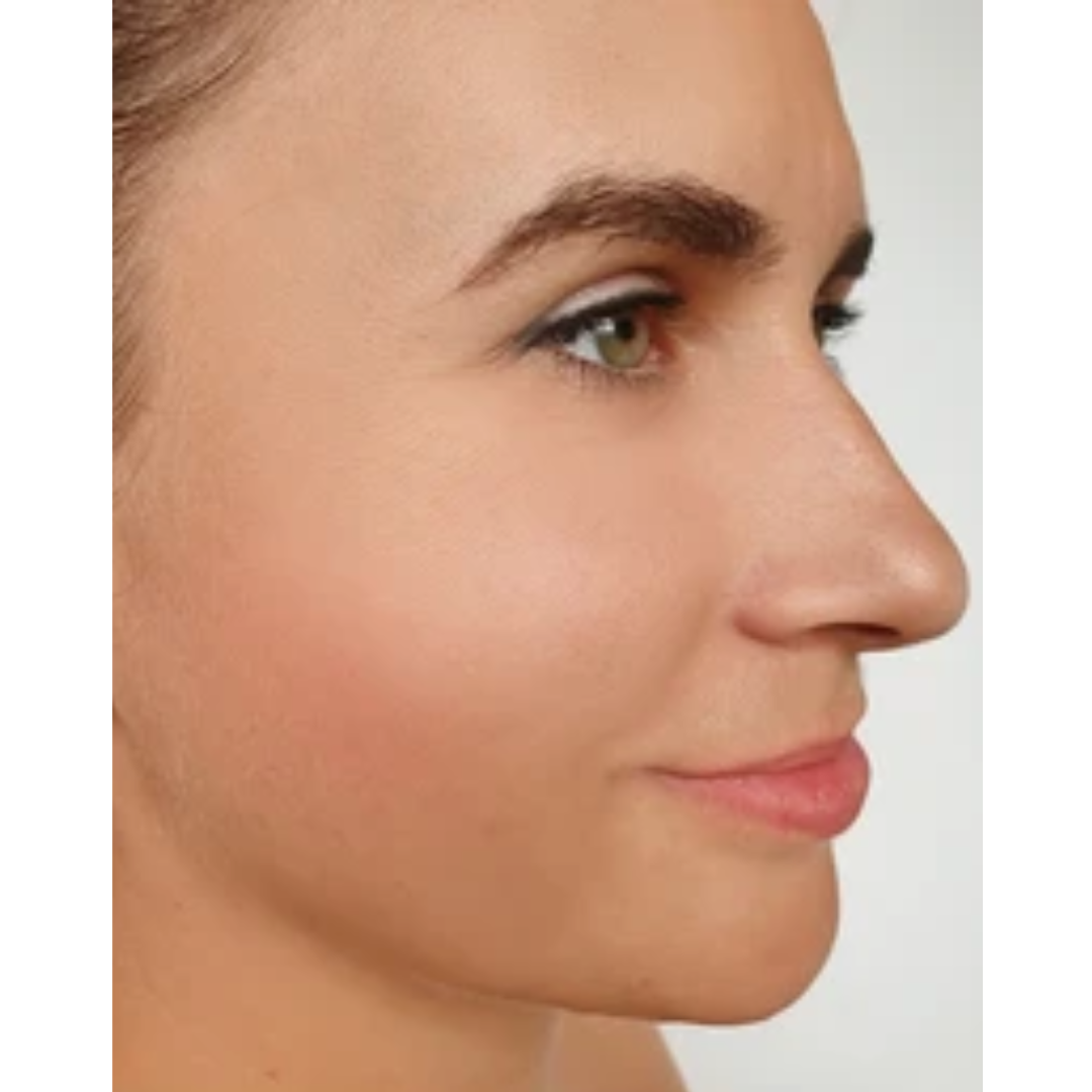 Nose after Rhinoplasty surgery