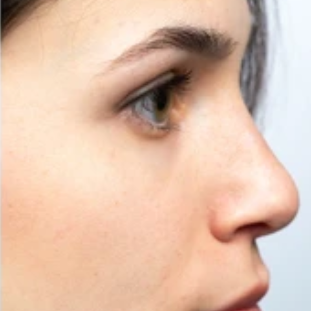 Nose after Rhinoplasty surgery