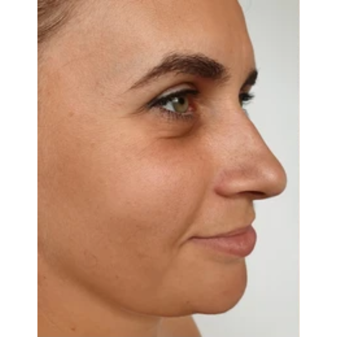 Nose before Rhinoplasty surgery