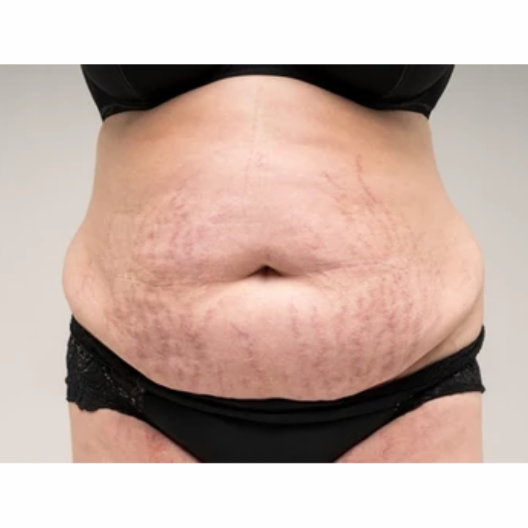 Scars Before Laser Scar Treatment