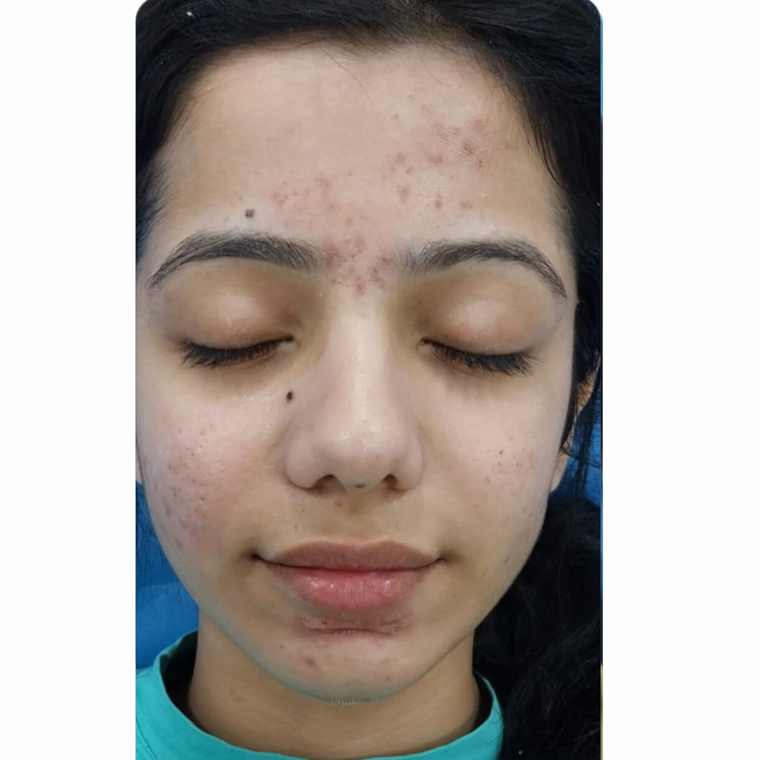 Picture after Acne Treatment