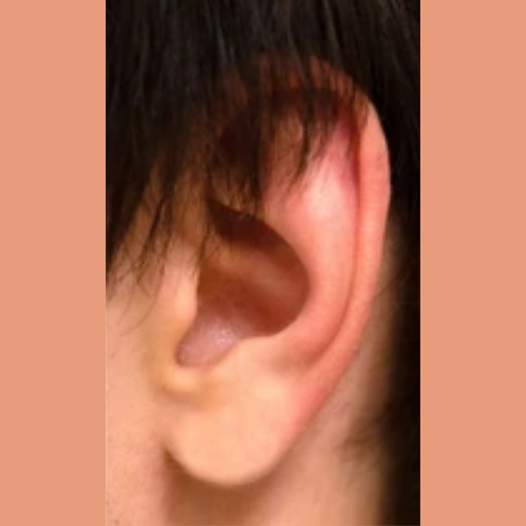 After Earlobe Reconstruction