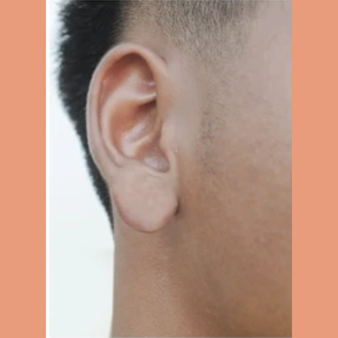 After Earlobe Reconstruction