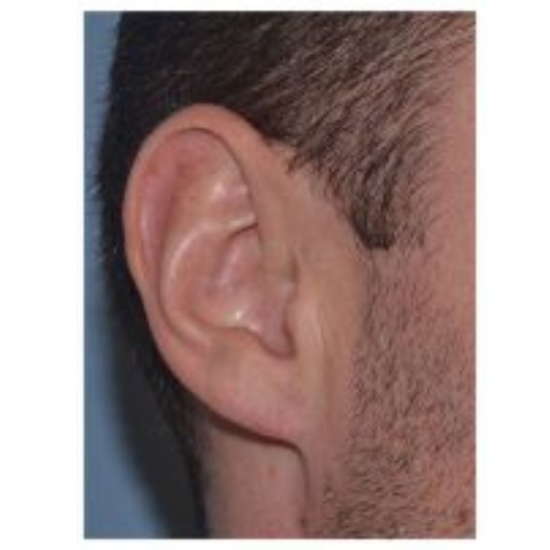 After Earlobe Reconstruction