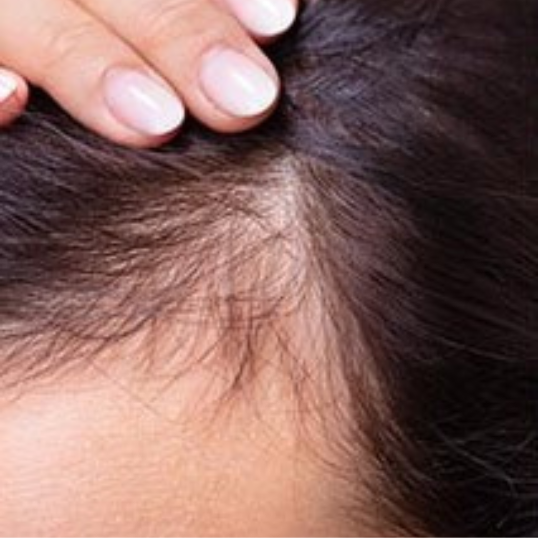 Hairs before mesotherapy Treatment