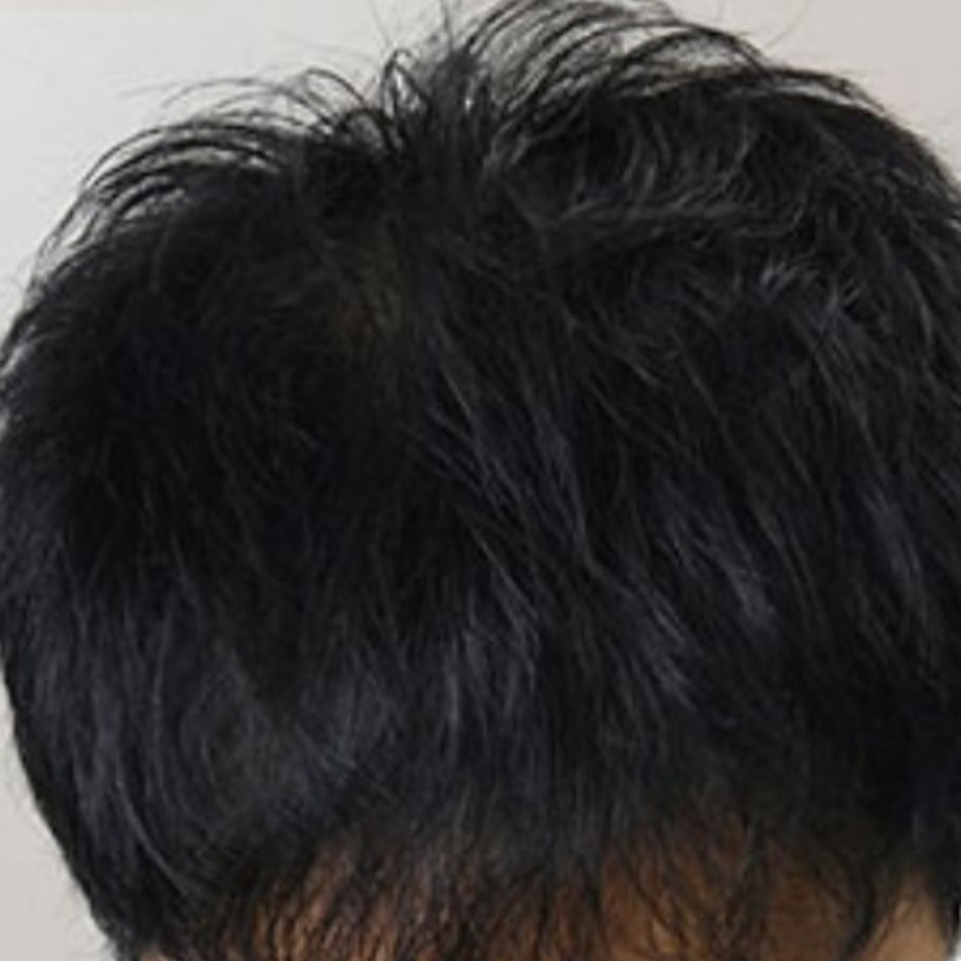 Hairs after mesotherapy Treatment