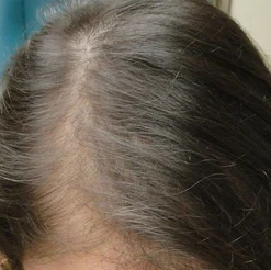 Hairs after mesotherapy Treatment