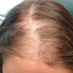 Hairs before mesotherapy Treatment