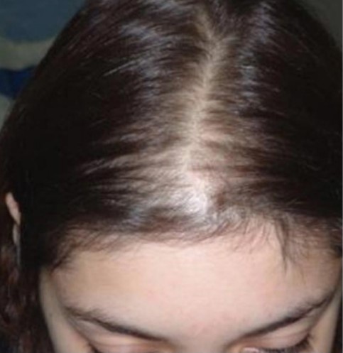Hairs before PRP Hair Treatment