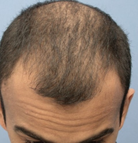 Hairs before PRP Hair Treatment