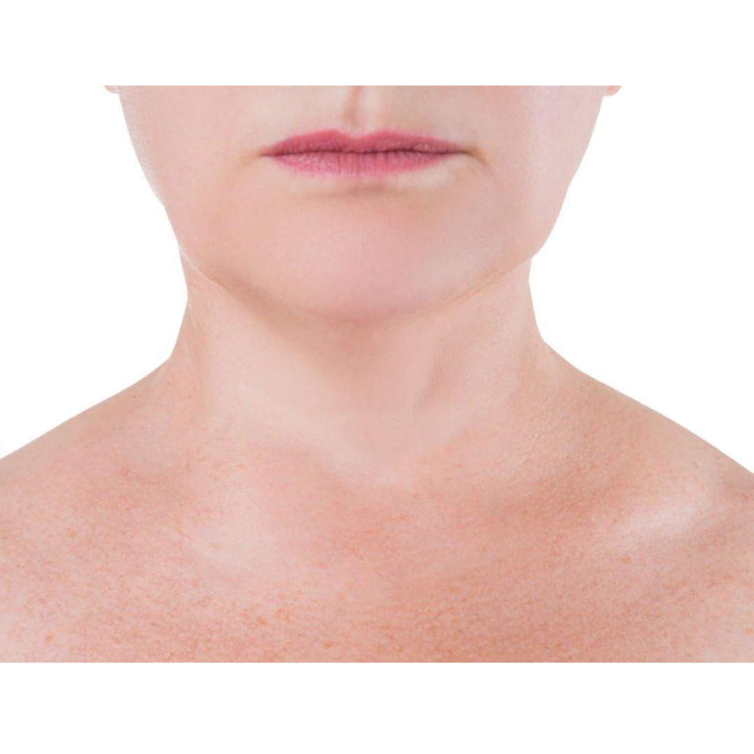 After Surgical skin tightening
