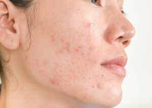 Types Of Acne Treatment in Dwarka, Delhi