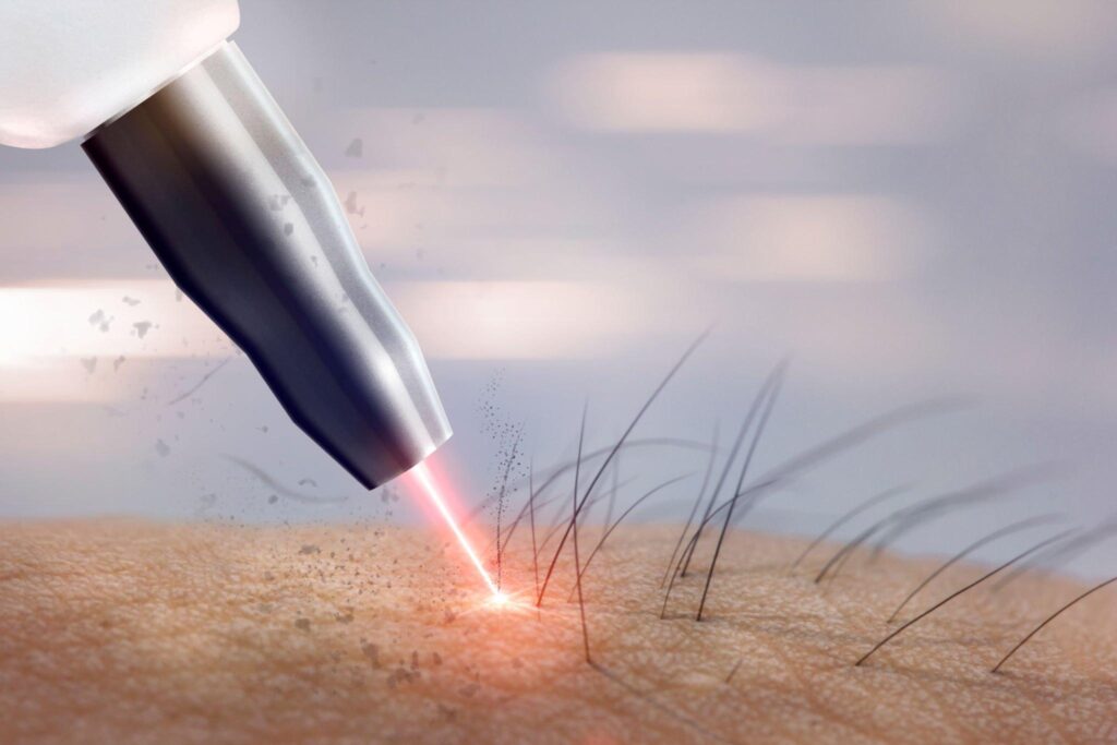 Laser hair removal in Dwarka