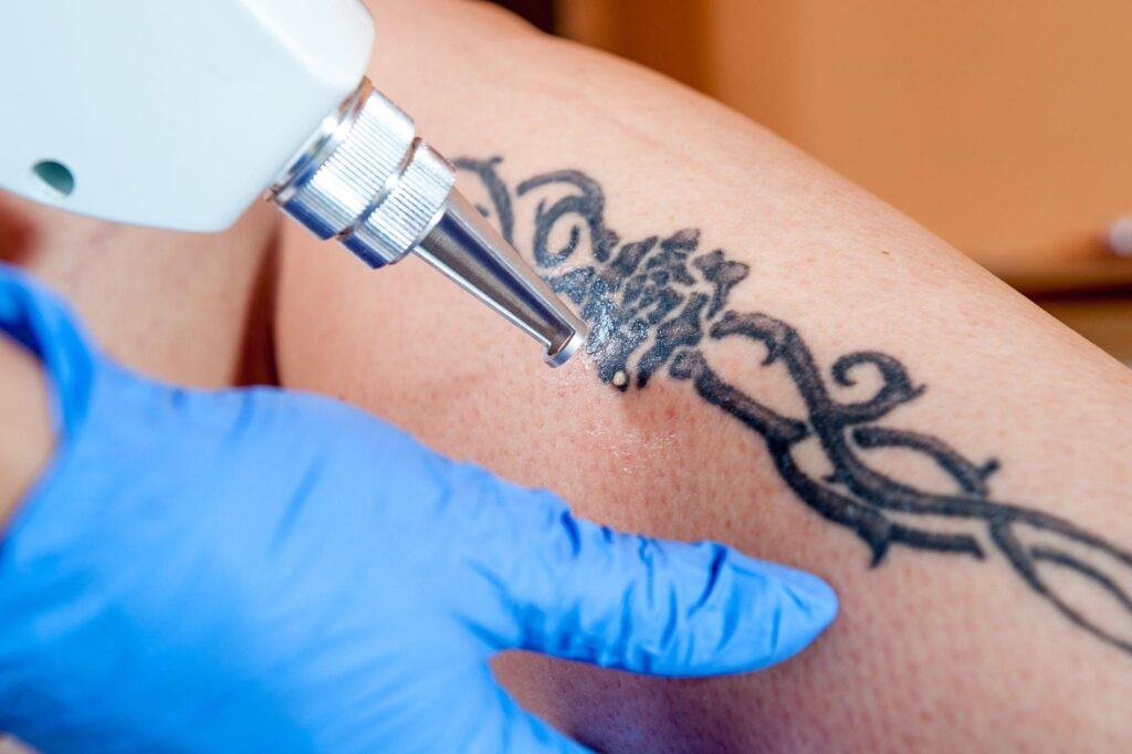 Permanent laser Tattoo Removal in Dwarka