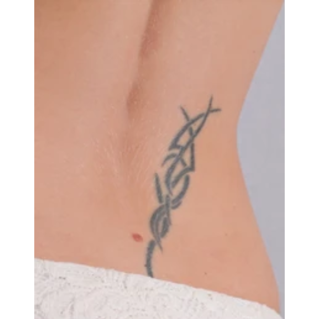 Body Before Permanent Tattoo Removal