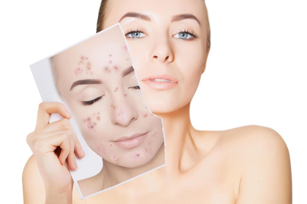 Process of Acne Treatment in delhi