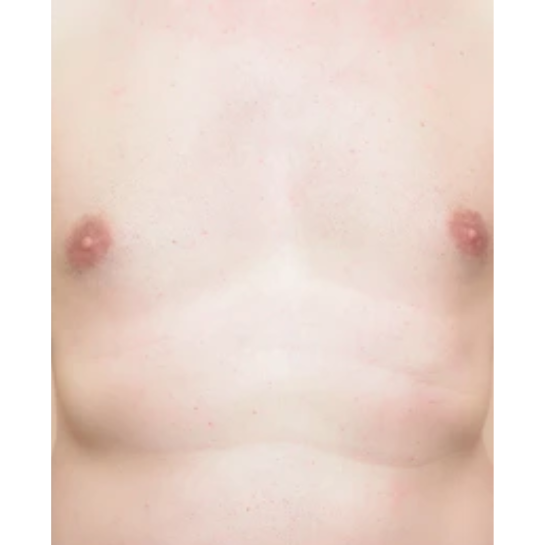 Chest after Laser hair Removal