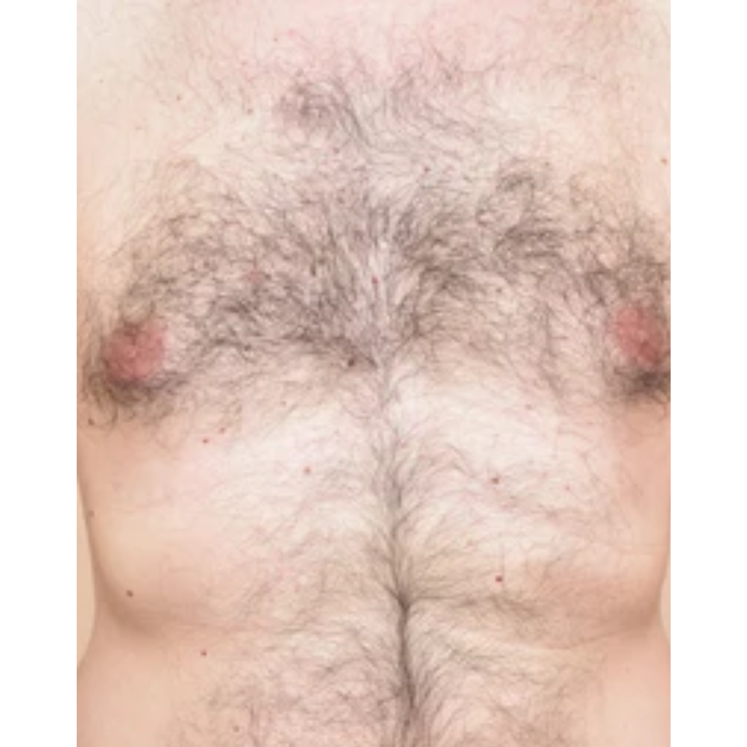 Chest Before Laser hair Removal