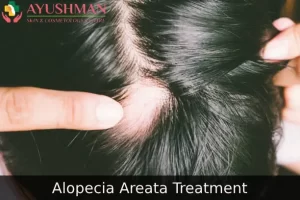 Image for Alopecia Areata Treatment