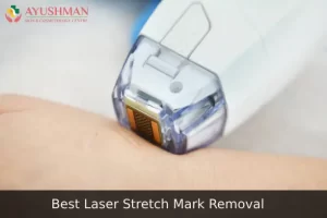 Best Laser Stretch Mark Removal