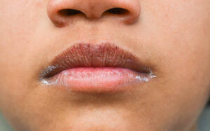 Image for Dry lips and peeling