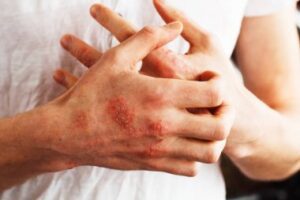 Image for Eczema Treatment