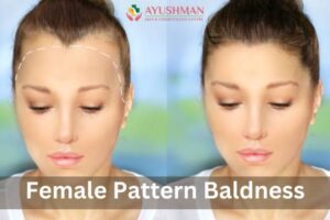 Female Pattern Baldness