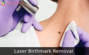 Image for Laser Birthmark Removal