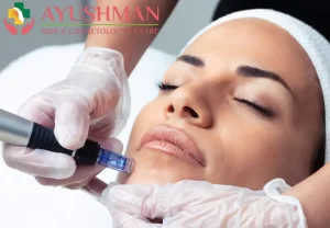 Microneedling Treatment in Dwarka