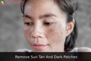 Image for Remove Sun Tan And Dark Patches