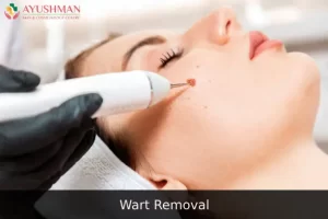 Image for Wart Removal