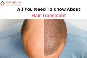 All You Need To Know About Hair Transplant