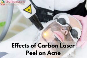 Effects of Carbon Laser Peel on Acne | Carbon Facial