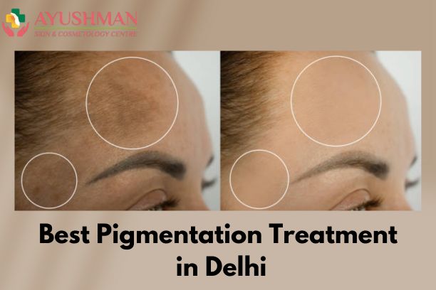 Pigmentation Treatment In Delhi