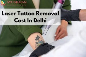 Laser Tattoo Removal Cost In Delhi