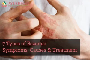 7 Types of Eczema: Symptoms, Causes & Treatment