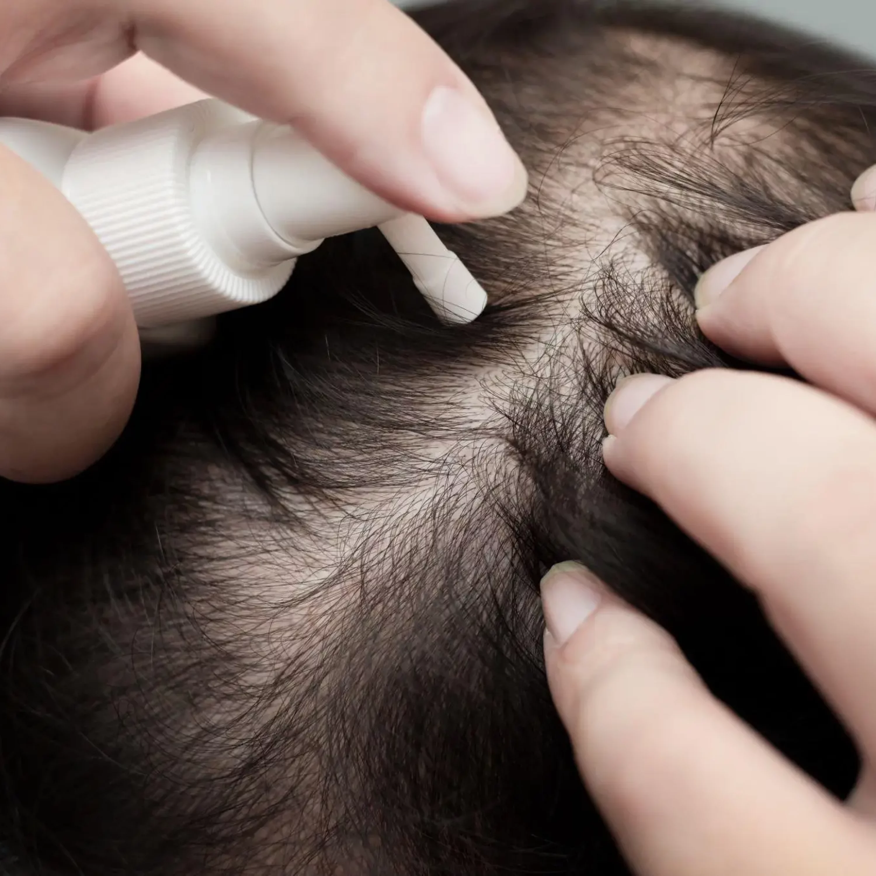 image for Hair loss treatment